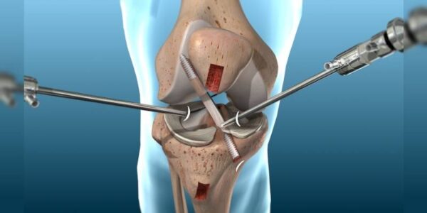 Can you walk after knee arthroscopy?