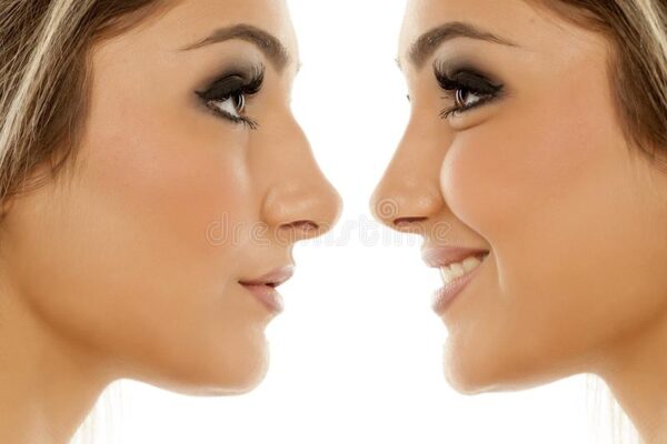 Rhinoplasty: the contraindications for the operation?