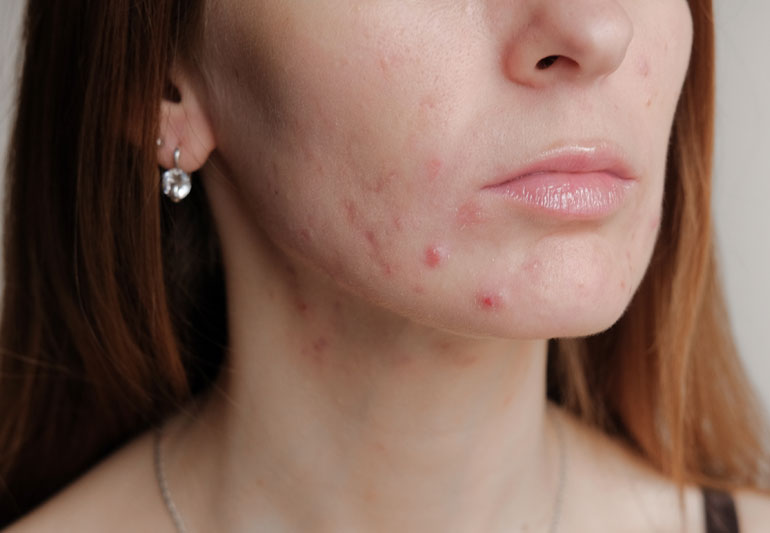How to Find a Good Hormonal Acne Clinic?