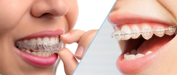 Is Invisalign North Shore Sydney Better Than Braces?
