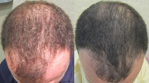 Things to Know Before PRP Hair Transplant