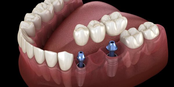 WHAT ARE THE BENEFITS OF DENTAL IMPLANTS?