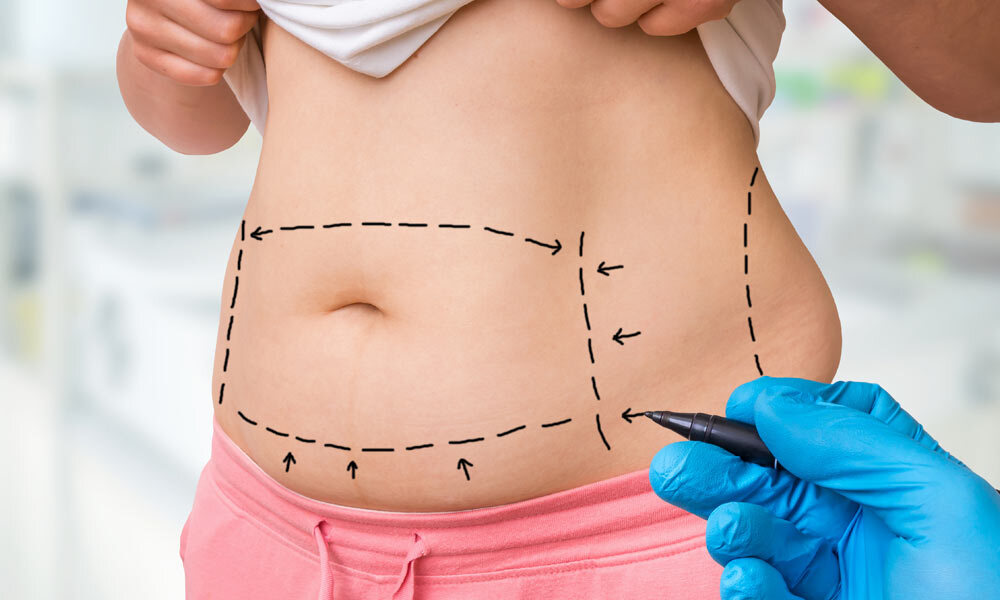 good candidate for a full tummy tuck
