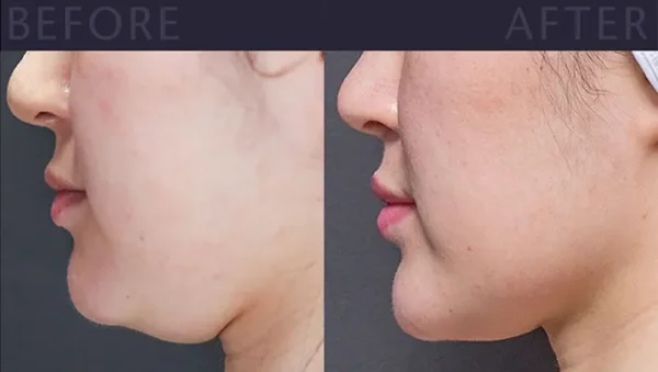 The Most Effective Non-Invasive Double Chin Removal Treatments