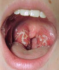 Tonsil Stones: Symptoms, Diagnosis, and Effective Treatment Options
