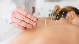 What You Need to Know About Acupuncture for Tinnitus