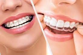 6 Benefits of Dental Aligners over Dentures