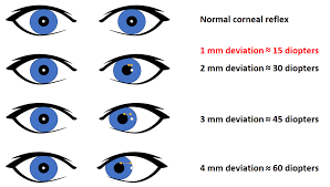 What Is the Significance of DifferentPupil Sizes to Pupillary Evaluation?